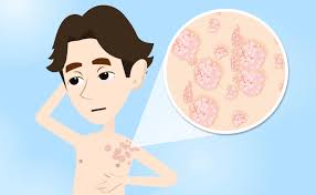 Psoriasi e sole