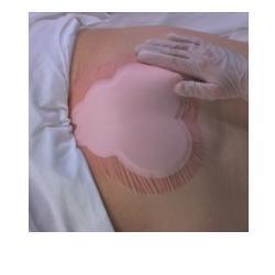 MEDICAZIONE IDROCELLULARE ADESIVA STERILE CONFORMATA PER LA REGIONE SACRALE ASSORBENTE IN SCHIUMA DI POLIURETANO ALLEVYN SACRUM 22,5X22,1CM 10PZ - Farmaciapacini.it